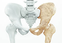 drkmh-Osteoporosis upper limb bones
