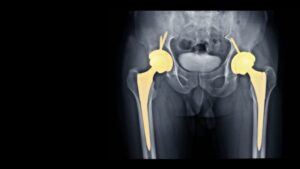 TOTAL HIP REPLACEMENT (THR)