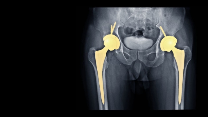 drkmh TOTAL HIP REPLACEMENT (THR)