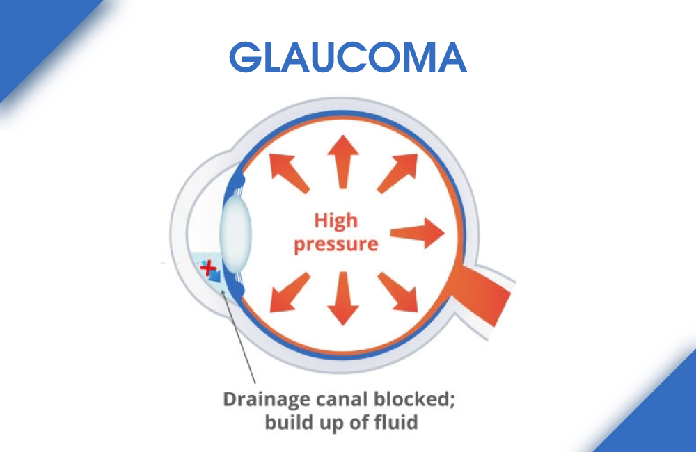 drkmh blog glaucoma