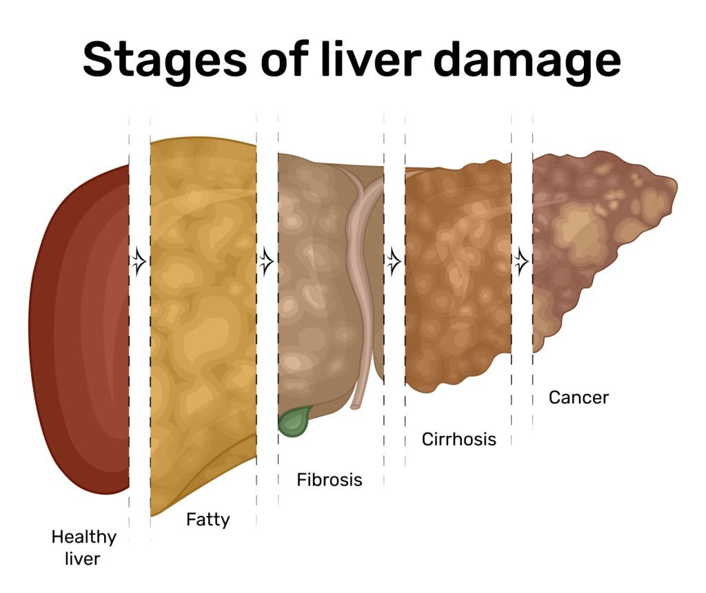 drkmh Understanding Fatty Liver Disease