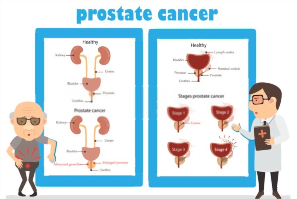 DRKMH Prostate Cancer FAQ's