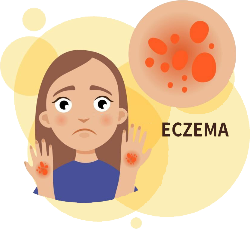drkmh TOP TEN ECZEMA TRIGGERS TO WATCH OUT FOR
